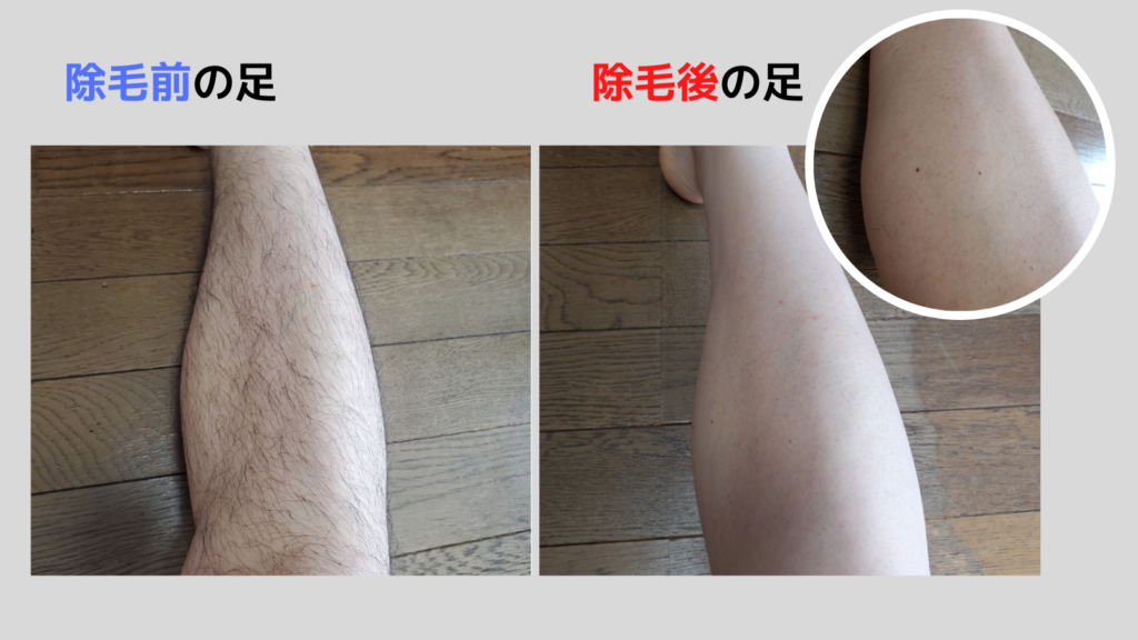 Zリムーバーの使用beforeとafter