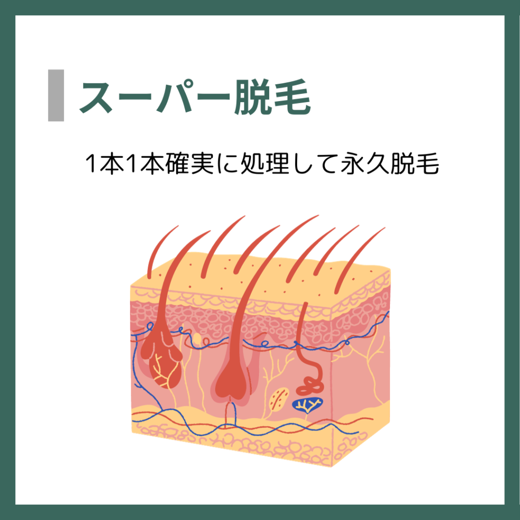 スーパー脱毛
1本確実に処理して永久脱毛