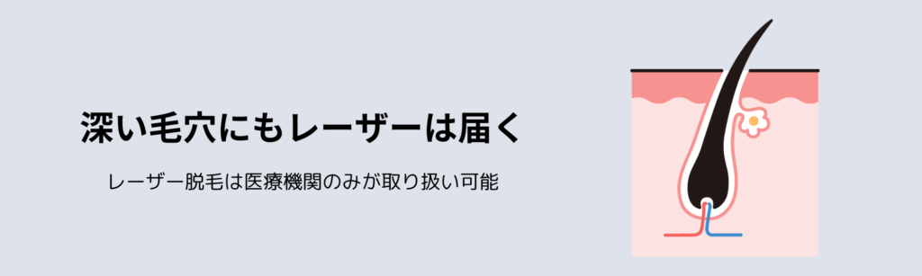 深い毛穴にもレーザーは届く
レーザー脱毛は医療機関のみが取り扱い可能